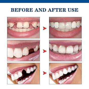 Teeth Gap Filler,Neyared Chipped Tooth Repair, Replacement Missing Teeth Gap Filler, Teeth Glue,  Temporary Moldable Granules