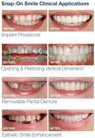 Snapon Smile/ veeners/ snap on smile veerners / veeners braces/Snapon Smile Teeth/ Snapon Smile Veeners/ Snapon Smile Artificial Teeth/ silicon braces/ Artificial teeth